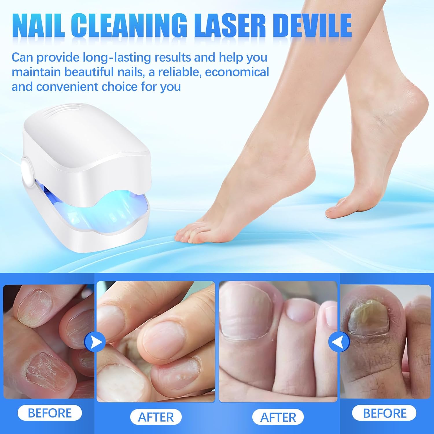 12915 Rechargeable Nail Fungus Treatment for Toenail, Toe Nail Fungal Treatment Nail Fungus Laser Device, Anti-Fungal Nail Treatment for Hand & Feet Infections Remover for Home Use